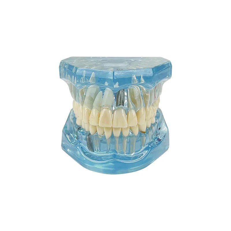 VVDental Teeth Repair Model Disease Teeth Model for Dentist Student Practice Training Studying Oral Medical Dentistry Tools