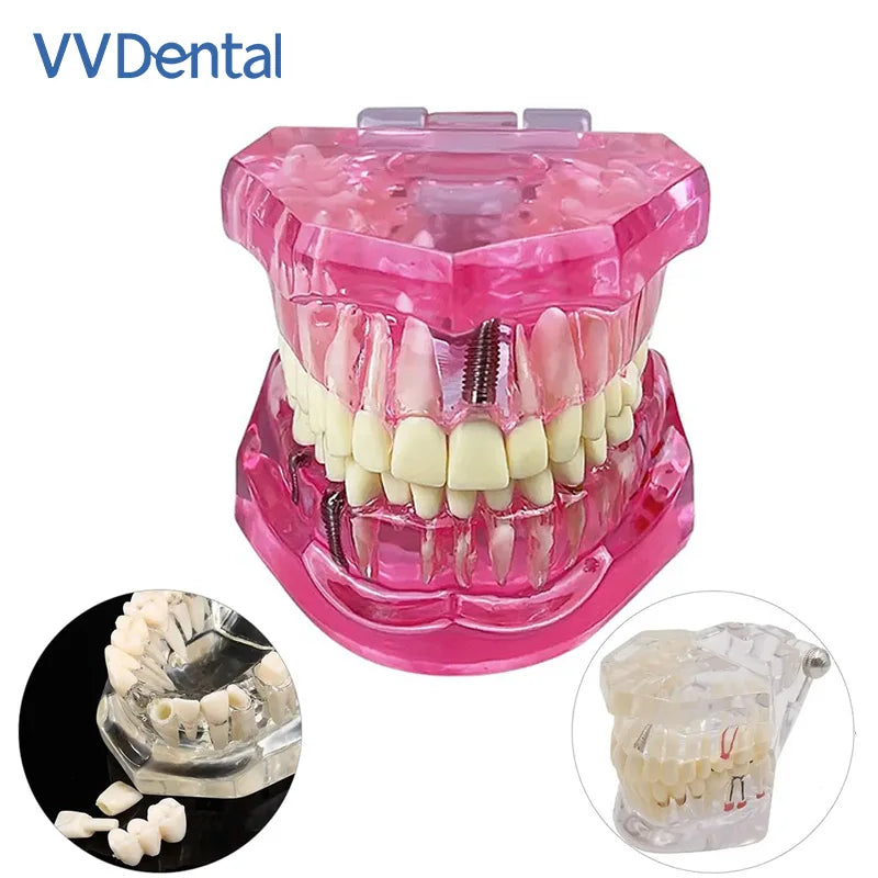 VVDental Teeth Repair Model Disease Teeth Model for Dentist Student Practice Training Studying Oral Medical Dentistry Tools